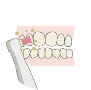 歯のクリーニングと自宅での使用法説明
